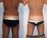 Liposuction