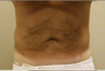 Liposuction