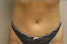 Liposuction
