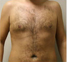 Liposuction
