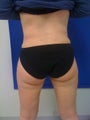 Laser Liposuction