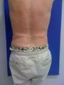 Laser Liposuction
