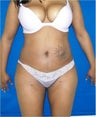 Laser Liposuction