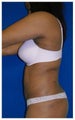 Laser Liposuction