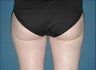 Thigh Liposuction