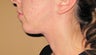 liposuction of double chin