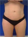 Thigh Liposuction