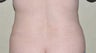Liposuction