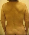 Liposuction of the back