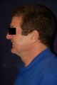 Liposuction