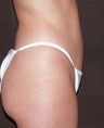 Liposuction