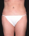 Liposuction