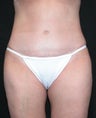 Liposuction