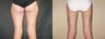 Liposuction Thighs