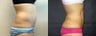 Liposuction of the Abdomen and Flanks