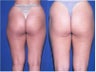 Liposuction