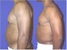 Liposuction