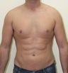 Male liposuction