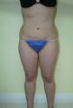 Liposuction