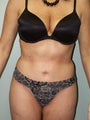 Liposuction