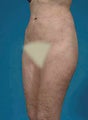 Liposuction