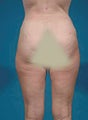 Liposuction