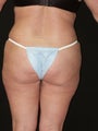 lipo and tummy tuck