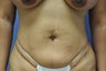 Liposuction of the abdomen