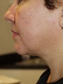 Liposuction Neck