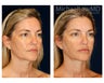 Liposuction - Jowls