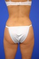 Liposuction