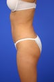 Liposuction