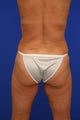 Liposuction