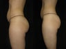Liposuction Abdomen