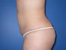 liposuction and buttocks fat grafting