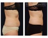 Liposuction