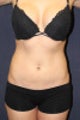 Liposuction of the abdomen, flanks, and hip rolls