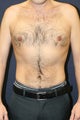 Liposuction of Abdomen and Flanks on Male
