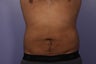 Liposuction