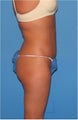 Abdominal Liposuction