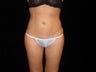 Liposuction