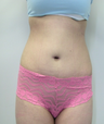 Lipo
