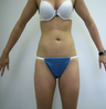 Lipo