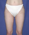 Liposuction