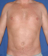 Liposuction of abdomen and flanks