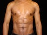 Lipouction with Six Pack Etching