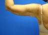 Liposuction - arms