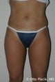 Liposuction