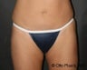Liposuction