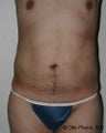 Male Liposuction